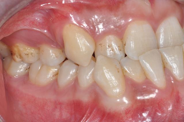孩子牙齿反颌是什么造成的