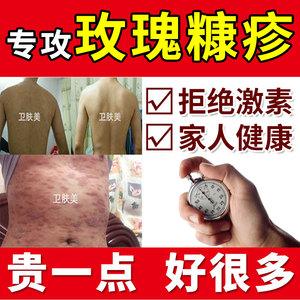 给孩子用外用激素膏要注意什么