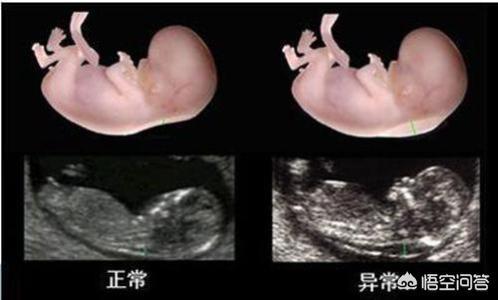 拍b超会不会影响胎儿