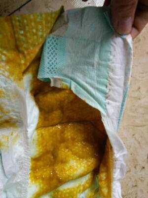 宝宝腹泻可以用蒙脱石散吗