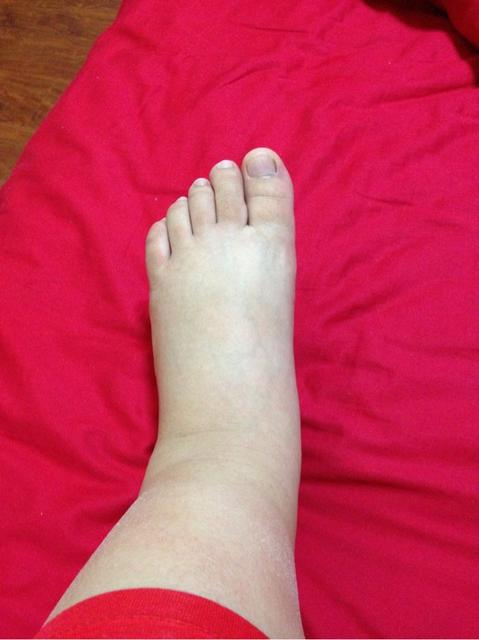 孕晚期脚肿怎么办缓解