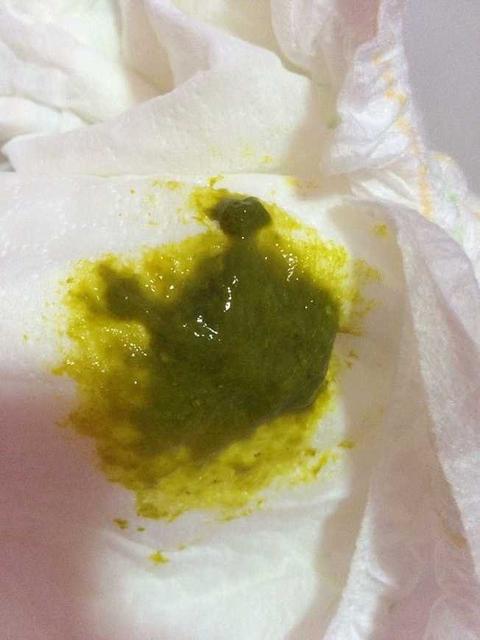 宝宝得急性肠胃炎严重吗