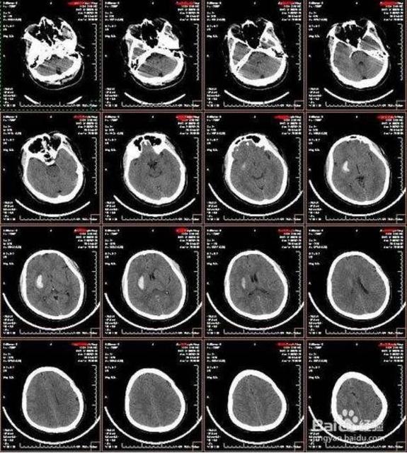 CT和核磁共振是一样的吗