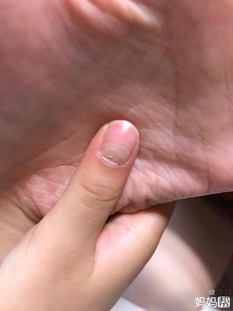 手足口病消退后为什么指甲会脱落
