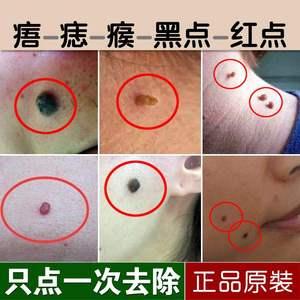 适用于点黑痣去肉痣无痕脸部点黑斑水黑点痦子祛志神器笔取痣贴