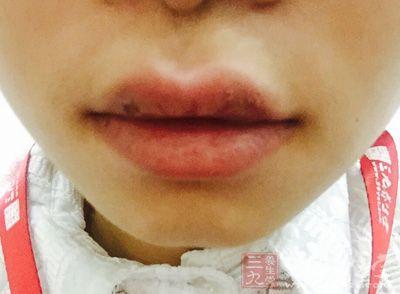 防晒喷雾喷到嘴唇上怎么办