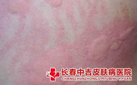 急性荨麻疹和慢性荨麻疹有什么区别