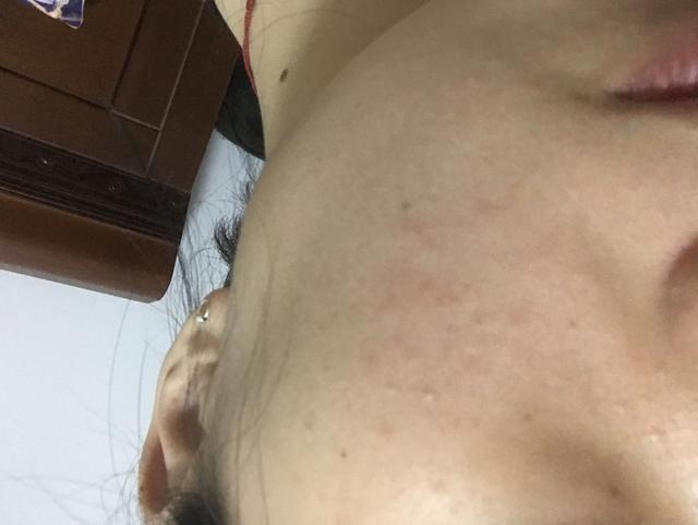 孩子过敏起疙瘩怎么办
