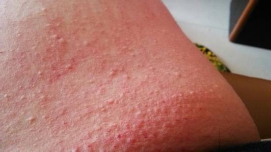 宝宝夏季常见肌肤问题的预防和护理