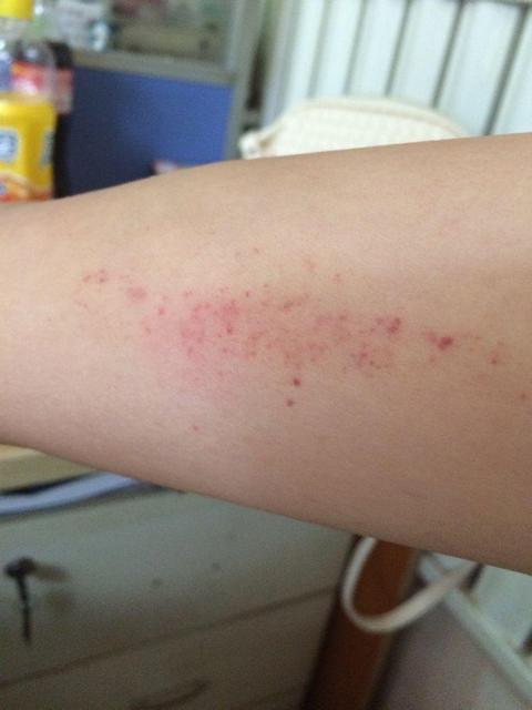 蚊子咬在人身体哪个部位最痒