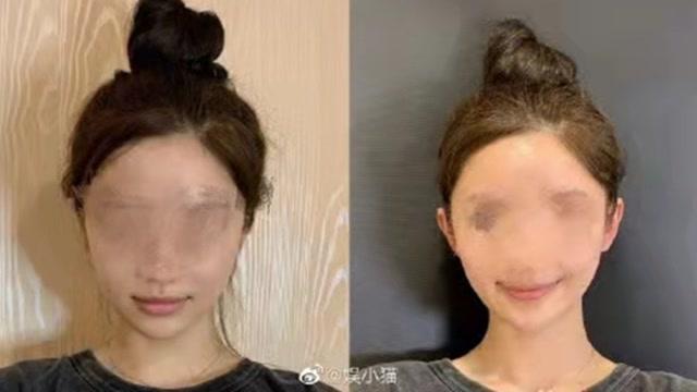 精灵耳朵整形要多少钱