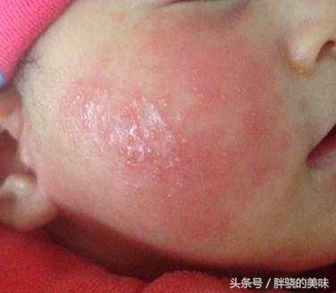 宝宝脸上起红疙瘩怎么回事