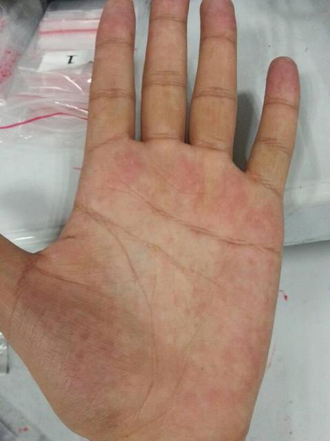 手指遇冷变紫怎么回事