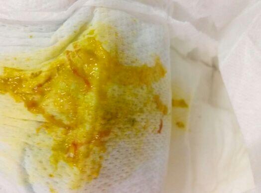 宝宝好几天没拉大便怎么办