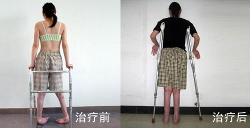 什么是内翻足外翻足