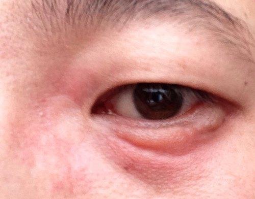 眼药水能直接滴在眼球上吗