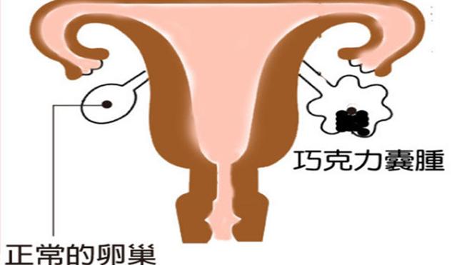 巧克力囊肿是什么
