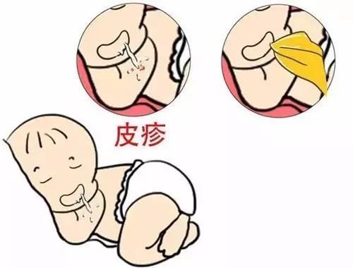 7个月宝宝食物过敏症状