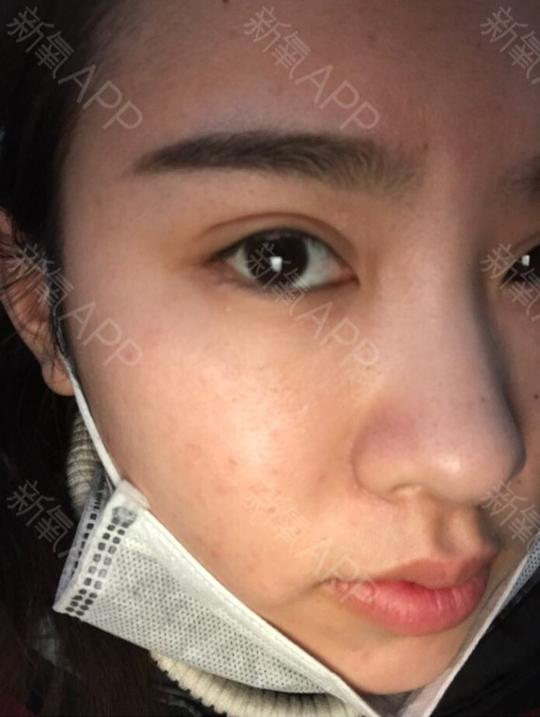 但是我这眼皮吧,左右眼适应程度不一样,左眼闭眼睛没有痕迹,右眼有一