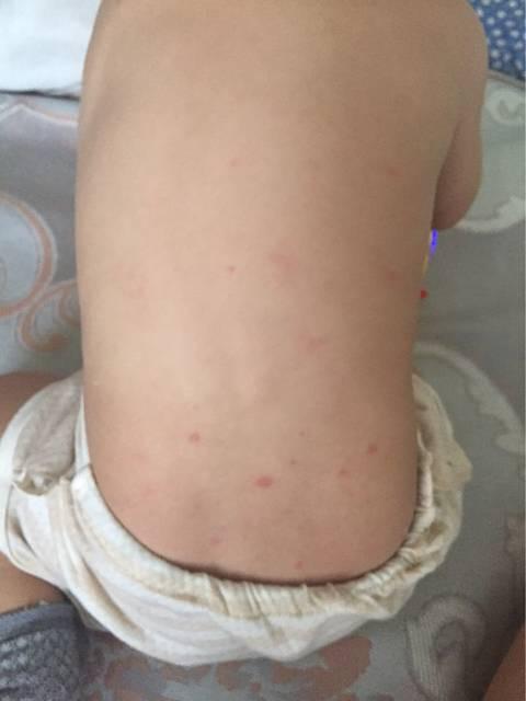 麻腮风疫苗和麻风疫苗怎么接种
