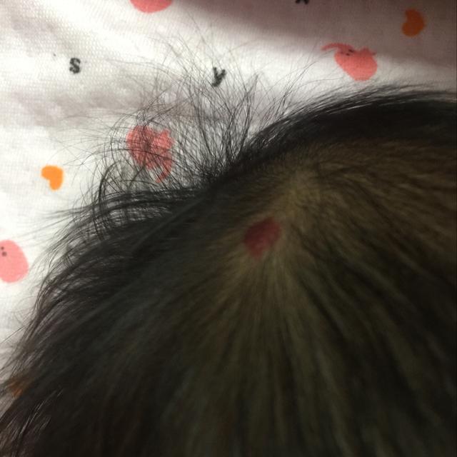 婴儿屁股下面有胎记有什么含义