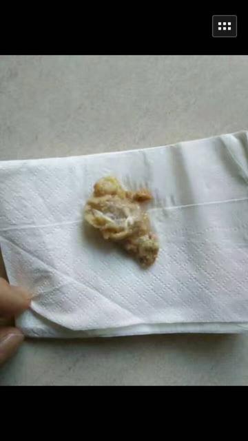 婴幼儿会有妇科炎症吗