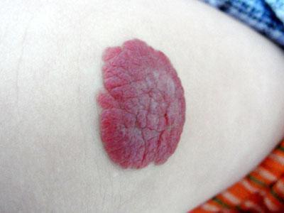 新生儿红色胎记和血管瘤的区别