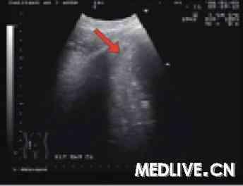 孕妇做超声检查有辐射吗