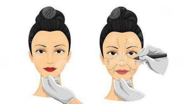 拉皮最佳年龄是多少岁