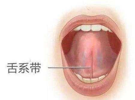 宝宝舌系带过短图片