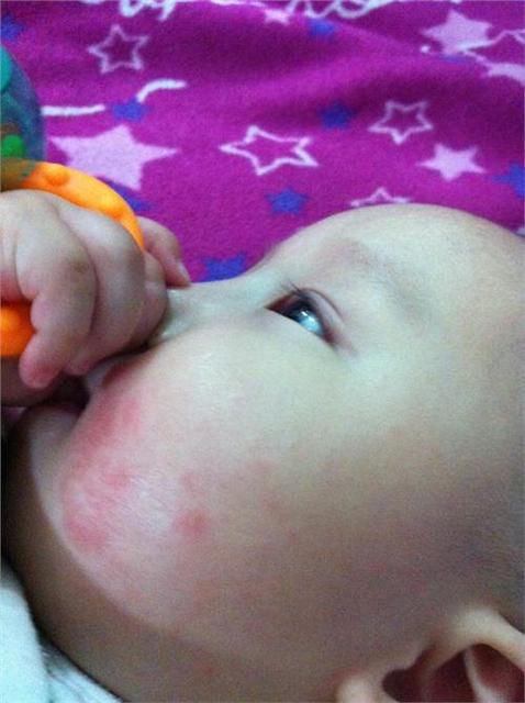 如何预防宝宝口水疹
