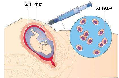 什么情况下会胎膜早破