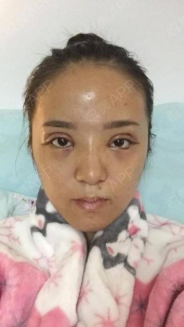 开眼角可以改善眼型么