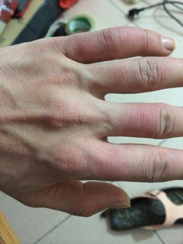 治疗宝宝冻疮的方法有哪些