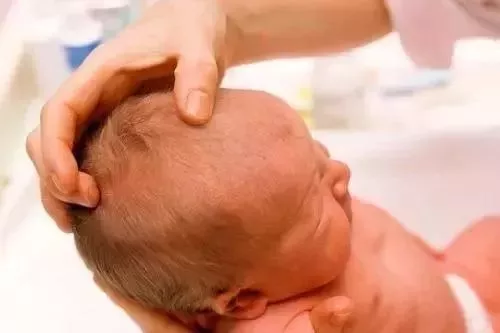 新生儿头皮上的乳痂是什么