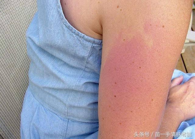 夏季晒伤修复小妙招