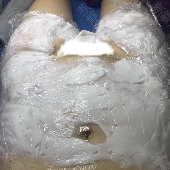 妊娠纹的发展过程图片