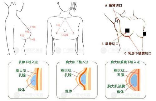 隆胸对哺乳有什么影响