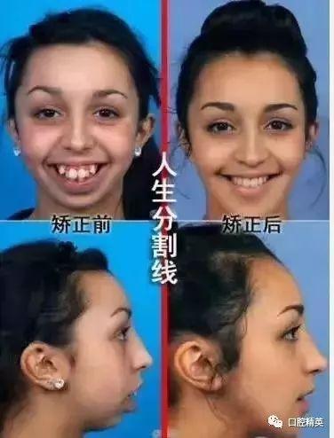 宝宝什么时候牙齿长全算正常