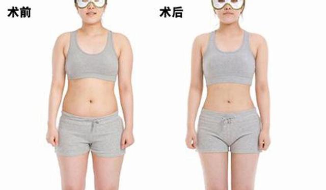 吸脂以后会不会导致皮肤松弛下垂