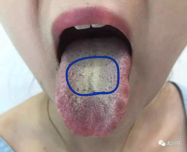 三岁宝宝湿气重怎么办
