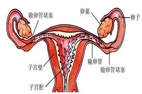 输卵管积水是哪些原因引起的