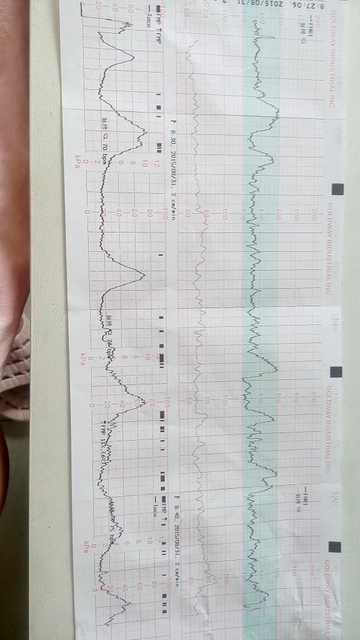 如何在胎心监护仪上看宫缩