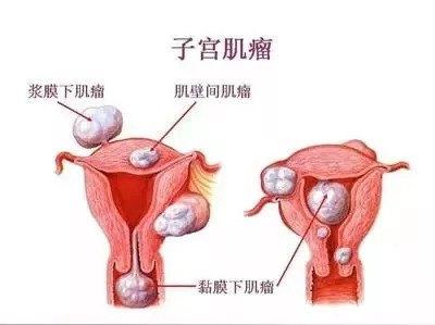 当怀孕遇上子宫肌瘤怎么办