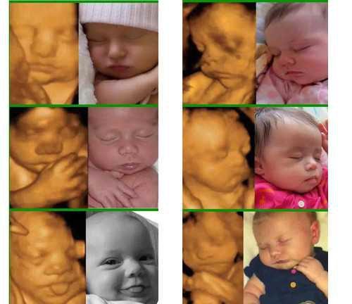 如何通过四维彩超图片看宝宝长相