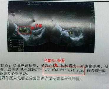 孕囊形状看性别准吗