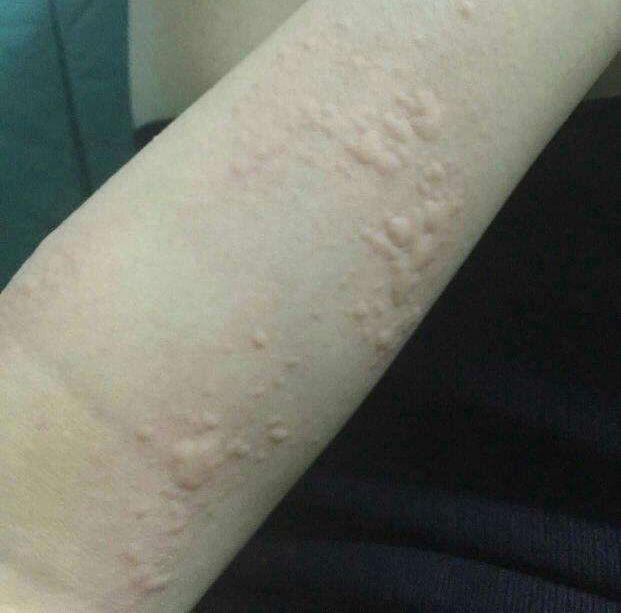 人工荨麻疹和荨麻疹有什么区别
