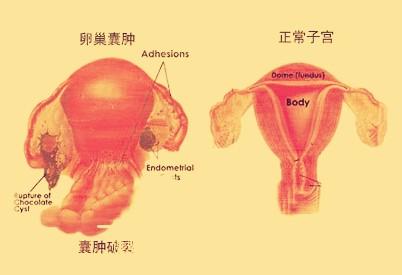卵泡囊肿怎么办?