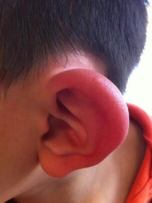 再造耳与真耳朵的区别