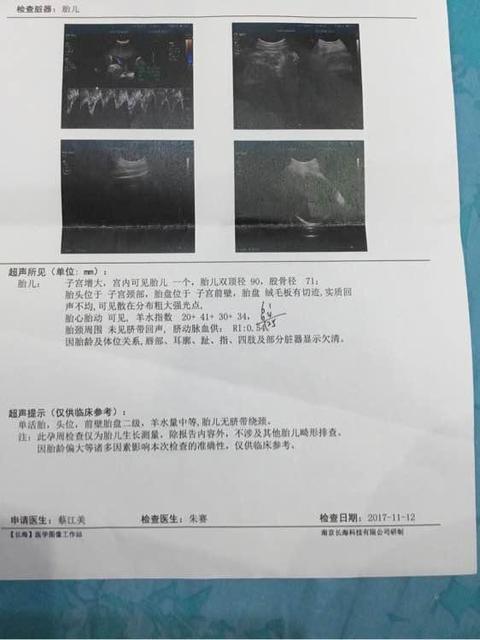 孕晚期胎动有哪些特征